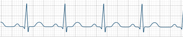 ECG tracing showing irregular, rapid heartbeats indicative of ventricular fibrillation.