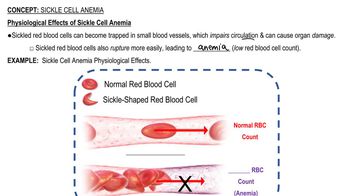 Sickle Cell Anemia