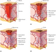Stages in wound healing