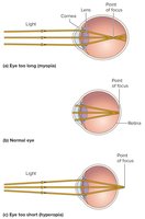 Myopia, normal eye, hyperopia