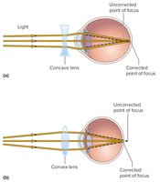 Lens correction for myopia and hyperopia