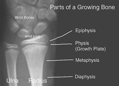 X-ray of growing bone with labeled epiphyseal plate