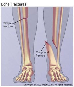 Table of common fracture types