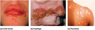 Examples of cold sores, impetigo, and psoriasis