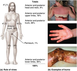 Rule of nines and examples of burns