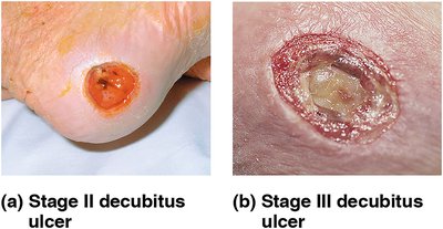 Stage II and III decubitus ulcers