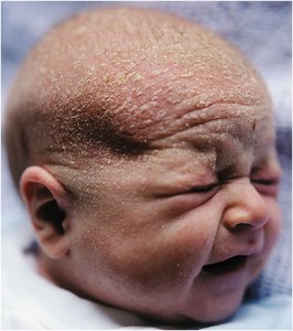 Newborn with vernix caseosa