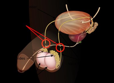 Male sterilization (vasectomy)