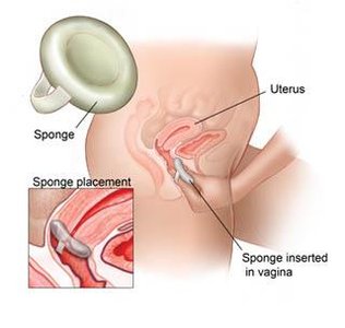 Contraceptive sponge placement