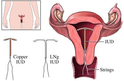 Types of intrauterine devices (IUDs)