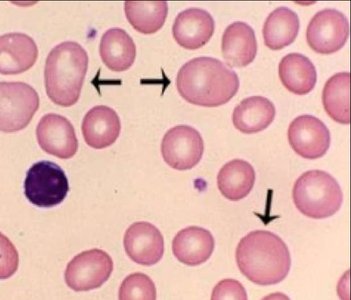 Iron-deficiency anemia blood smear
