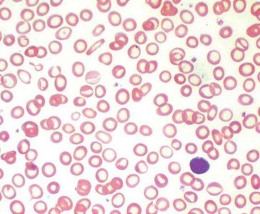 Pernicious anemia: megaloblastic cells