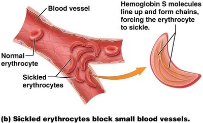 Sickled erythrocytes blocking blood vessels