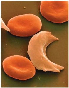 Sickled red blood cell among normal cells