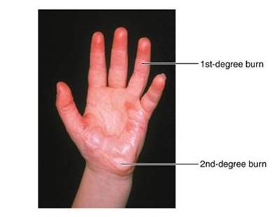 Partial-thickness burns: 1st and 2nd degree