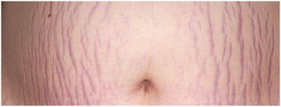 Stretch marks (striae) on the abdomen