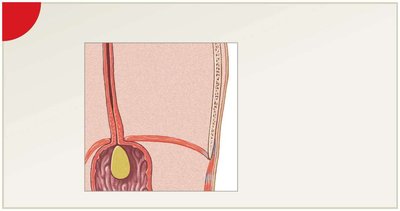 Bolus entering the stomach