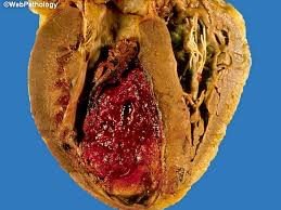 Heart tissue affected by myocardial infarction