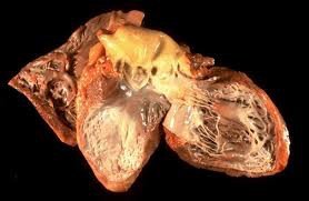 Heart tissue with scarring