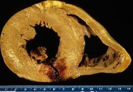 Cross-section of heart showing infarcted tissue