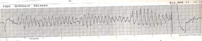 ECG paper grid and calibration