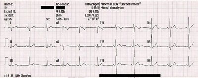 Abnormal ECG waves