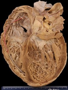 Normal heart vs. dilated cardiomyopathy