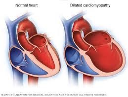 Heart with dilated cardiomyopathy