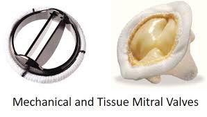 Mechanical and tissue mitral valves