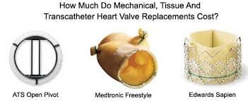 Types of heart valve replacements