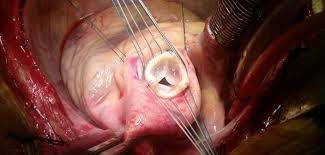 Surgical view of heart valve replacement