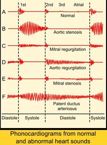 Phonocardiograms of normal and abnormal heart sounds