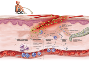 Inflammatory response at the site of injury