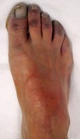 Peripheral cyanosis in the foot