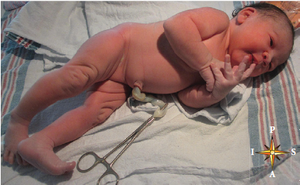 Neonate (newborn infant)