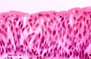 Distended bladder with transitional epithelium
