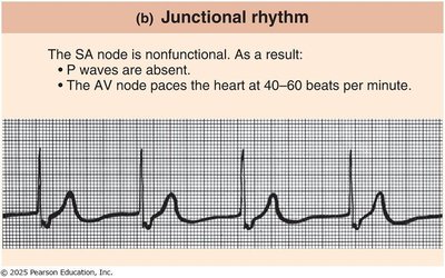 ECG showing junctional rhythm