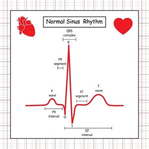 Normal sinus rhythm ECG