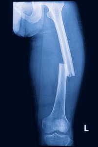 X-ray of a transverse fracture of the left femur