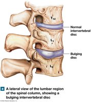 Bulging intervertebral disc