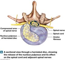 Herniated disc