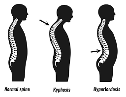 Normal spine, kyphosis, and hyperlordosis