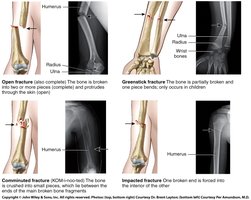 Types of bone fractures: open, greenstick, comminuted, impacted