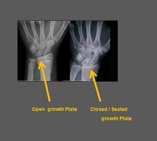 Open and closed growth plate in X-ray images