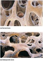 Normal versus osteoporotic bone architecture