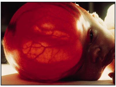 Infant with hydrocephalus showing enlarged head due to CSF accumulation