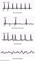 ECG patterns of dysrhythmias