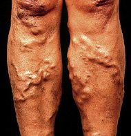 Photograph of varicose veins