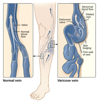Diagram of varicose vein pathology