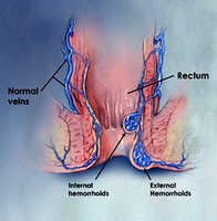 Diagram of internal and external hemorrhoids